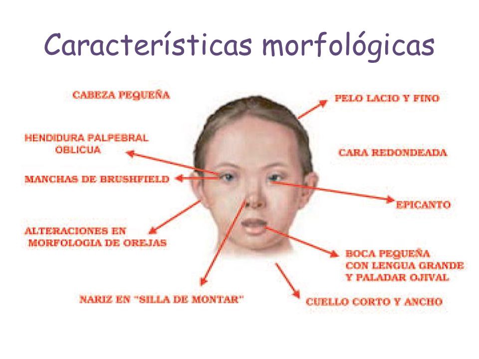 Características morfologicas del niño con Síndrome de Down